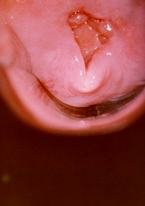 Diethylstilbestrol (des) cervix (11) photo