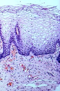 Diethylstilbestrol (des) cervix (34)