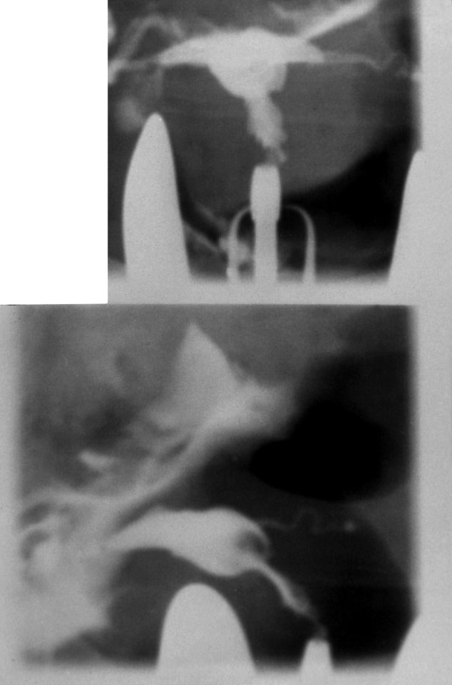 Diethylstilbestrol (des) cervix (43)