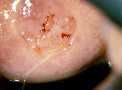 Diethylstilbestrol (des) cervix (8) photo