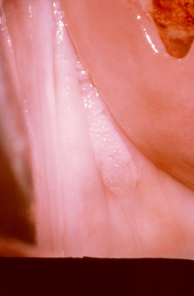 Diethylstilbestrol (des) cervix (15)