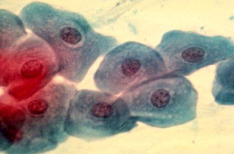 Diethylstilbestrol (des) cervix (38)