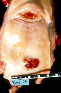 Diethylstilbestrol (des) cervix (47)