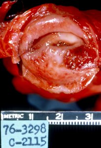 Diethylstilbestrol and (des) cervix