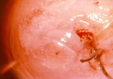 Diethylstilbestrol (des) cervix (19)