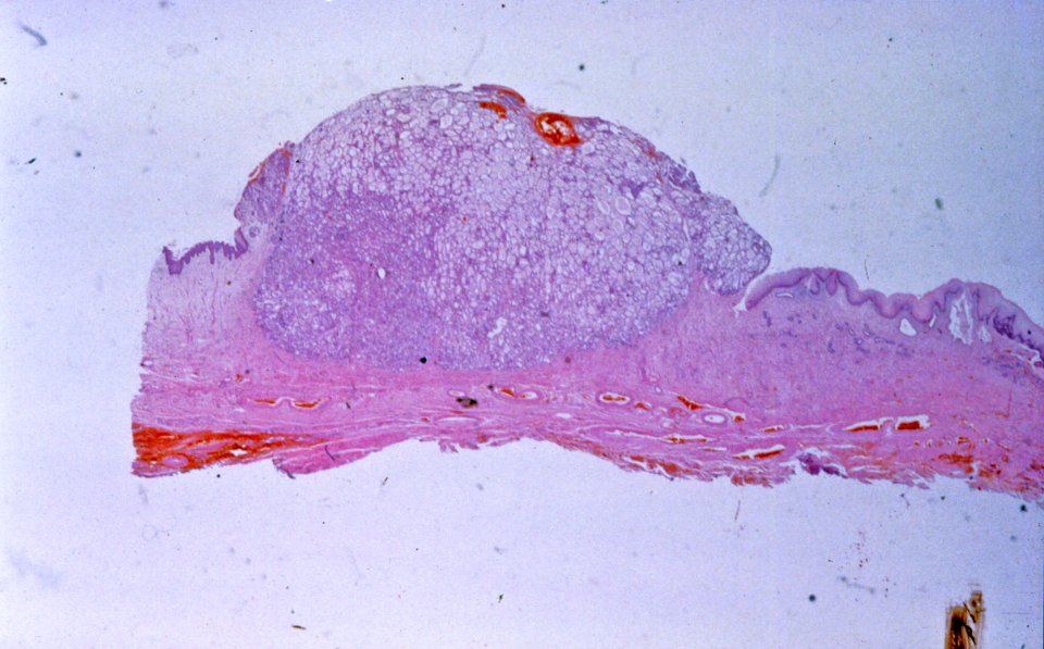 Diethylstilbestrol (des) cervix (50)
