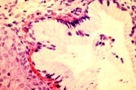 Diethylstilbestrol (des) cervix (22)
