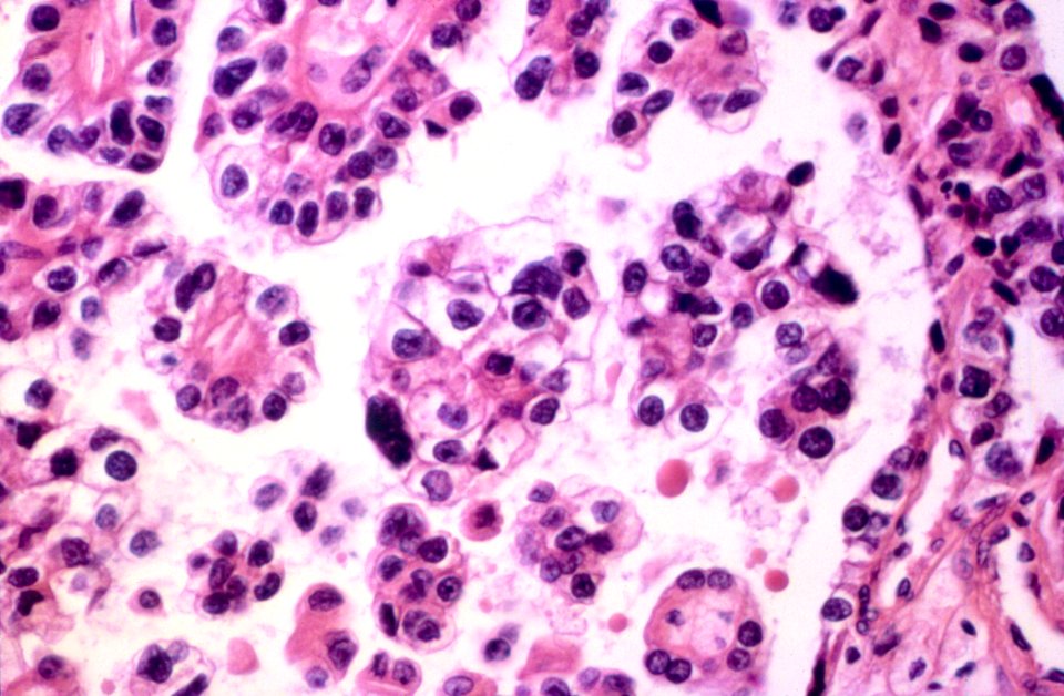 Diethylstilbestrol (des) cervix (54)