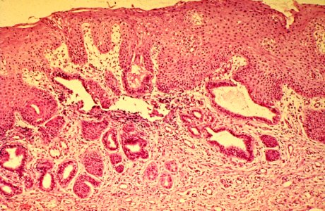 Diethylstilbestrol (des) cervix (26)