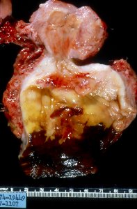 Diethylstilbestrol (des) cervix (49)