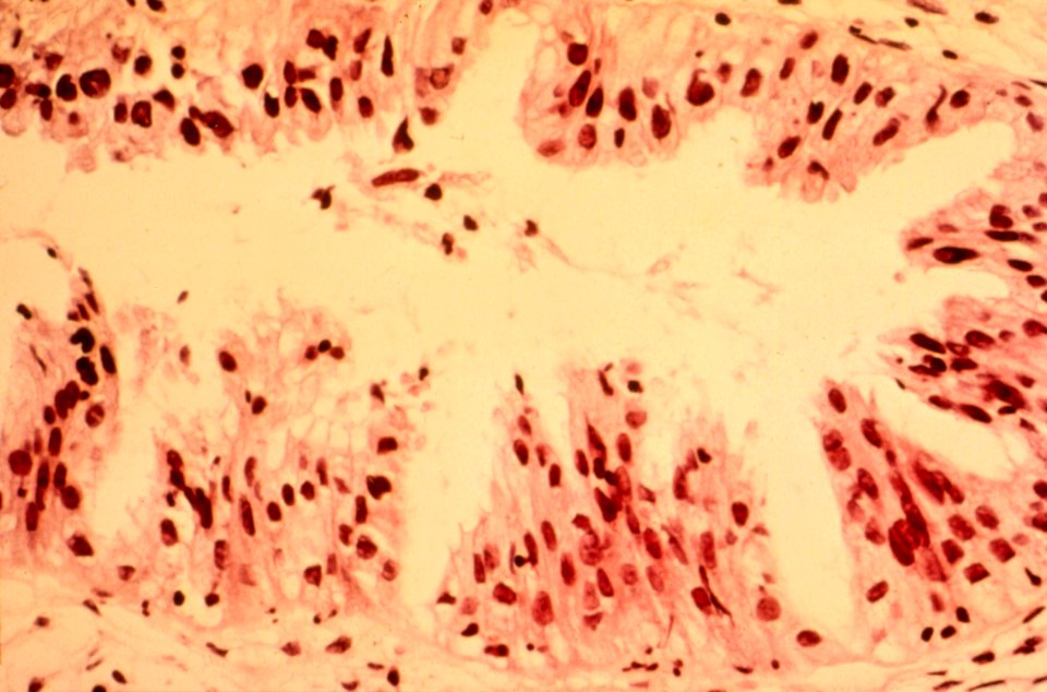 Diethylstilbestrol (des) cervix (58)