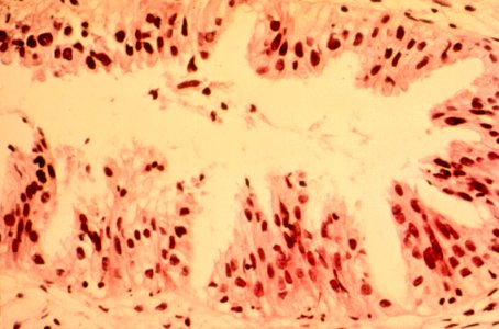 Diethylstilbestrol (des) cervix (58)