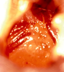Diethylstilbestrol (des) cervix (3) photo