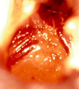 Diethylstilbestrol (des) cervix (3)