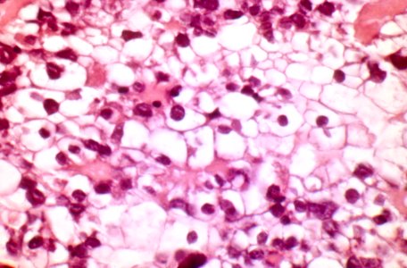 Diethylstilbestrol (des) cervix (52)