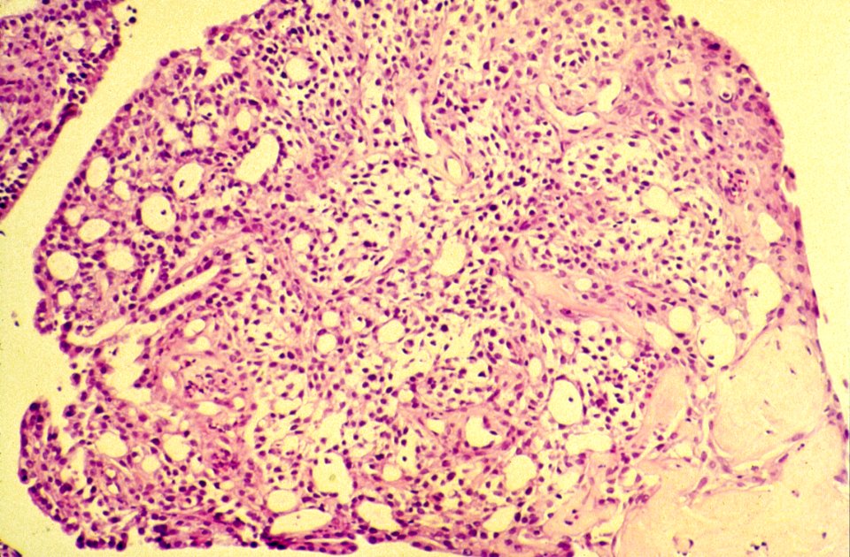 Diethylstilbestrol (des) cervix (61)