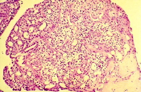Diethylstilbestrol (des) cervix (61)
