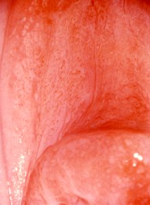 Diethylstilbestrol (des) cervix (33) photo