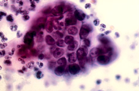 Diethylstilbestrol (des) cervix (56)