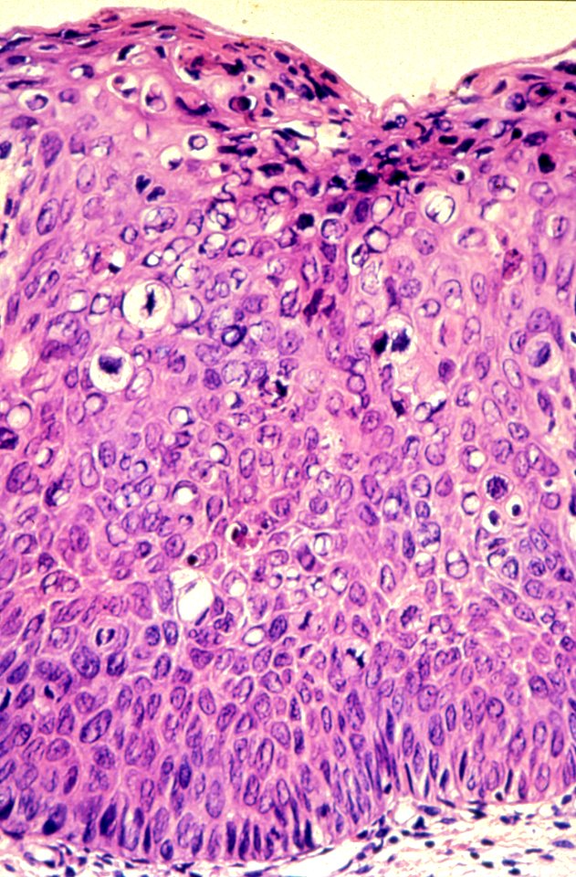 Diethylstilbestrol (des) cervix (65)