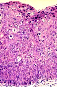 Diethylstilbestrol (des) cervix (65)