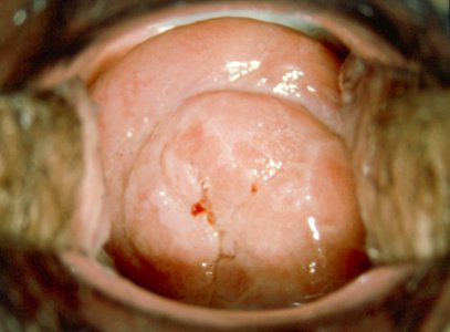 Diethylstilbestrol (des) cervix (6) photo