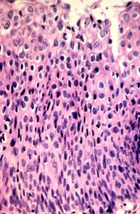 Diethylstilbestrol (des) cervix (69)