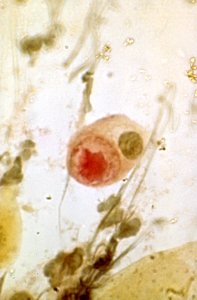 Diethylstilbestrol (des) cervix (40)