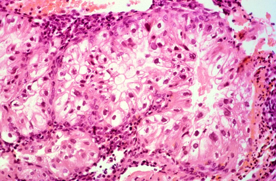 Diethylstilbestrol (des) cervix (63)