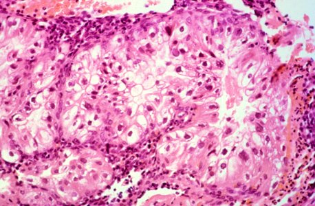 Diethylstilbestrol (des) cervix (63)