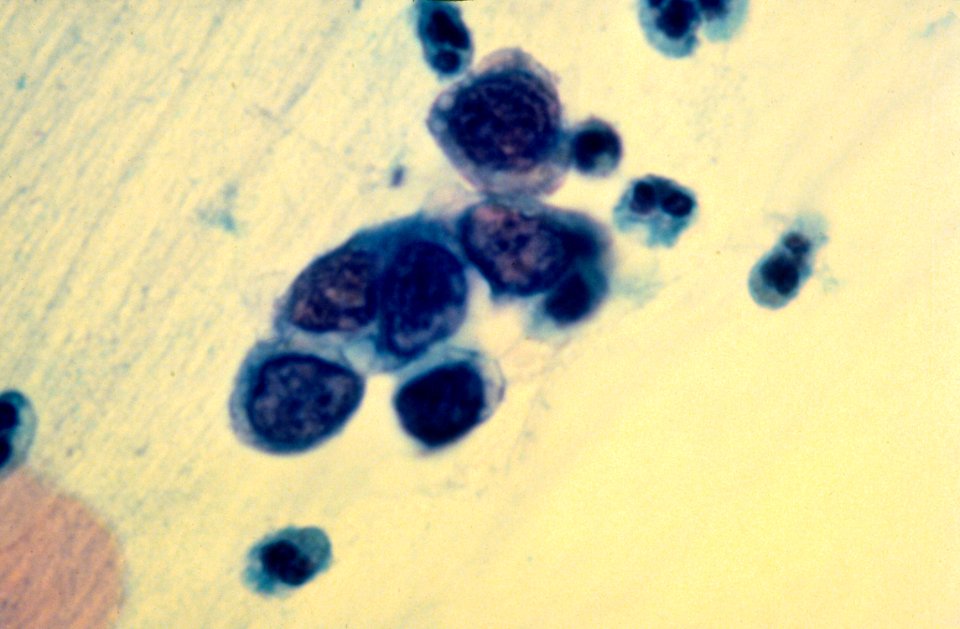 Diethylstilbestrol (des) cervix (67)