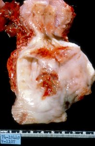 Diethylstilbestrol (des) cervix (48)