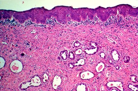 Diethylstilbestrol (des) cervix (51)