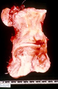 Diethylstilbestrol (des) cervix