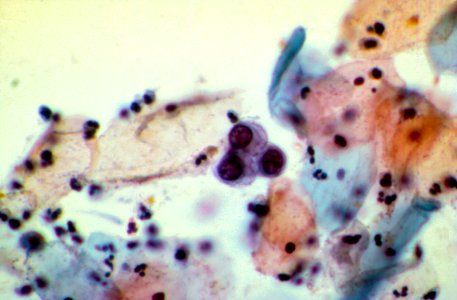 Diethylstilbestrol (des) cervix (55)