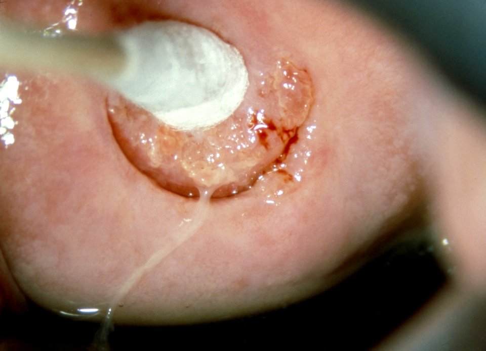 Diethystilbestrol (des) cervix