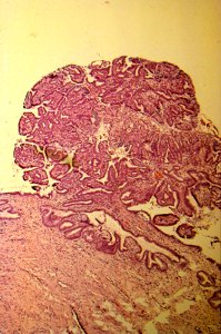 Diethylstilbestrol (des) cervix (59)