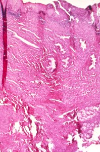 Diethylstilbestrol (des) cervix (62)