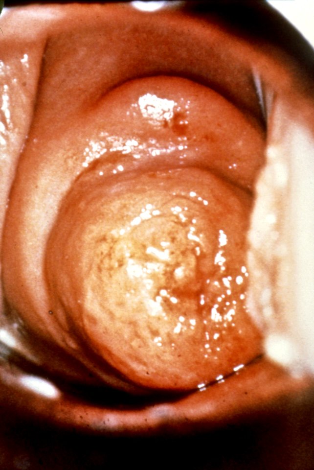 Diethylstilbestrol (des) cervix (7)