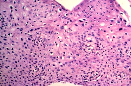 Diethylstilbestrol (des) cervix des photo