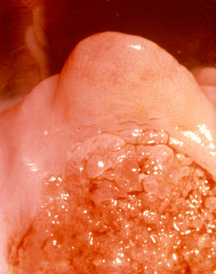 Diethystilbestrol (des) cervix (1)