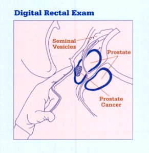 Digital Rectal Exam, extracted from Understanding treatment choices for prostate cancer (2000) photo