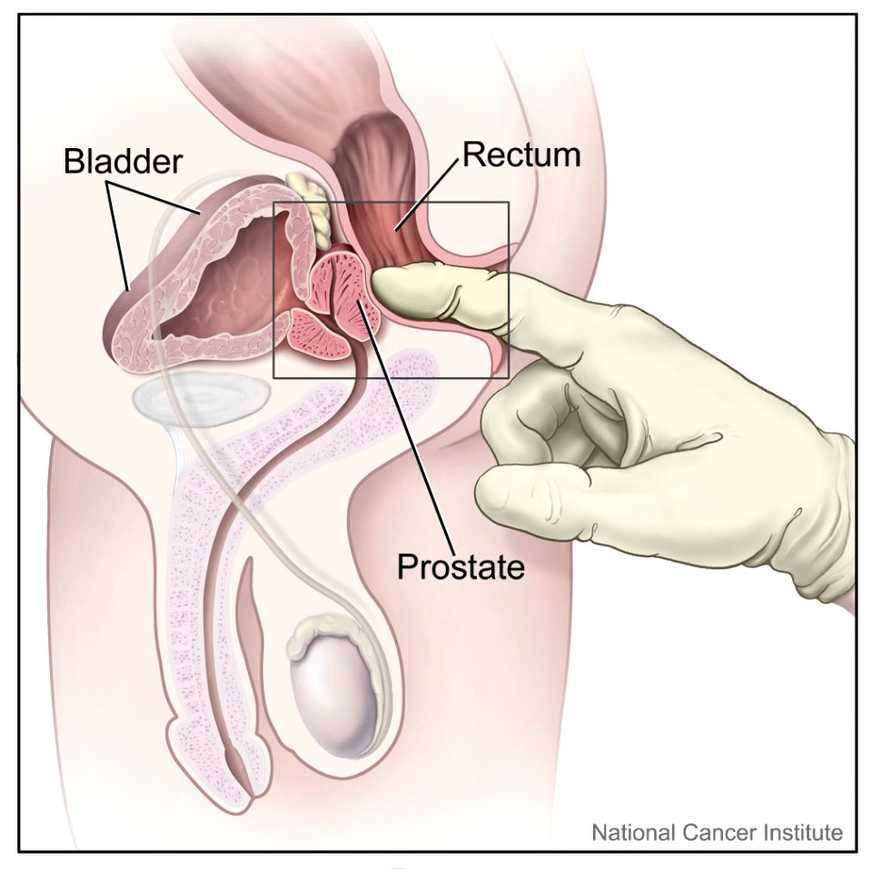 Digital rectal exam (male) photo