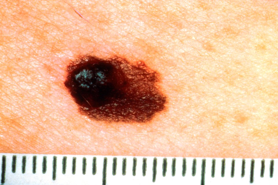 Asymmetrical melanoma