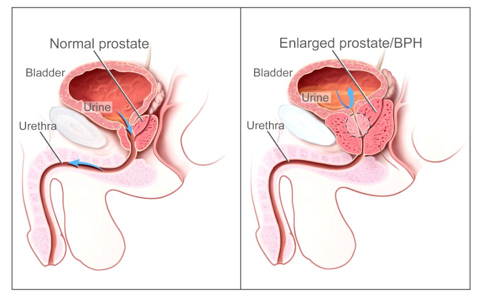 Benign Prostatic Hyperplasia nci-vol-7137-300