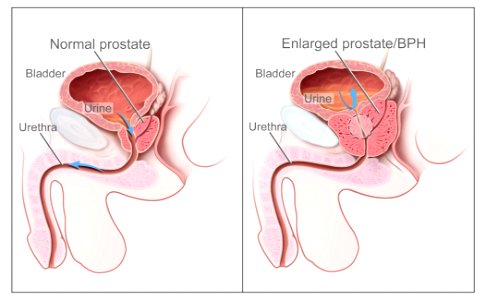 Benign Prostatic Hyperplasia nci-vol-7137-300 photo