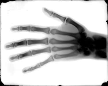 Buckwalter X-Ray Hand
