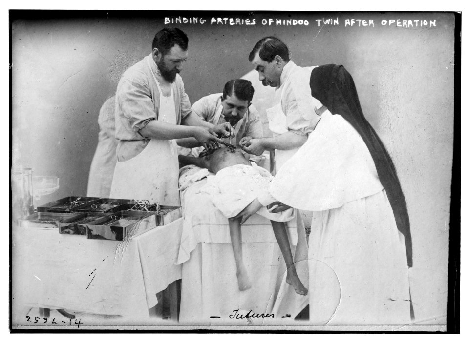 Binding arteries of Hindoo twins after operation LCCN2014691063