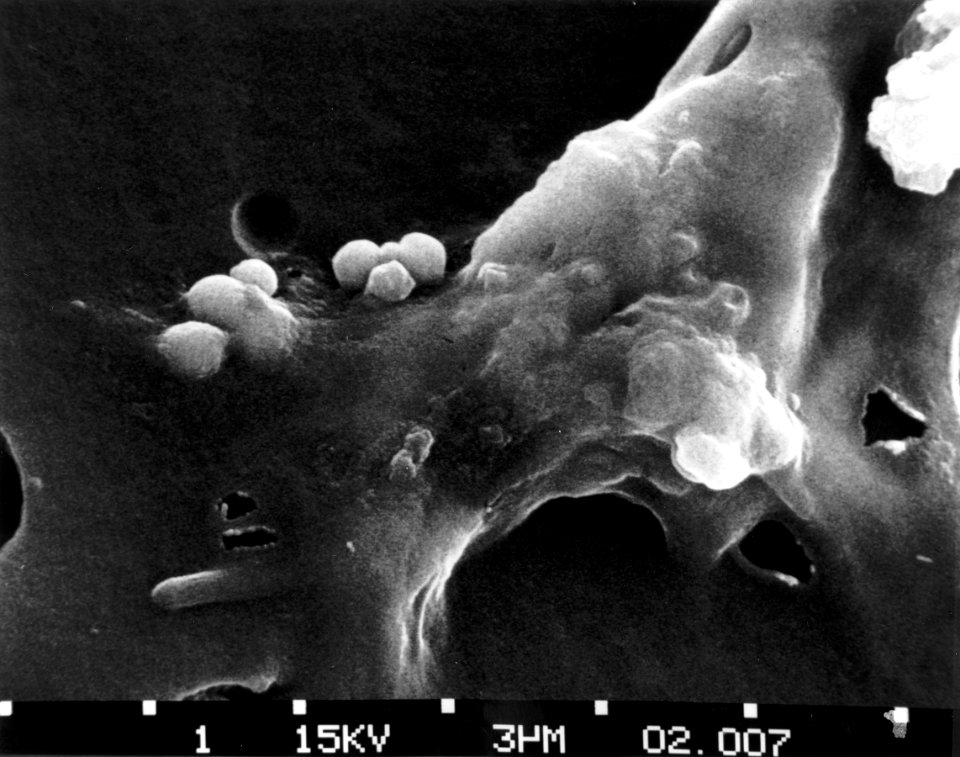 Cancer cells- death (step 4)