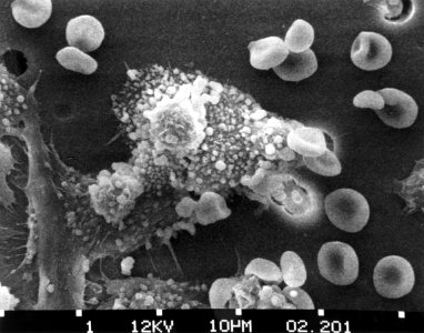 Cancer cells- death (step 3)